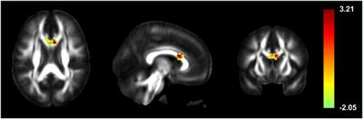 Functional Connectivity of the Corpus Callosum in Epilepsy Patients with Secondarily Generalized Seizures